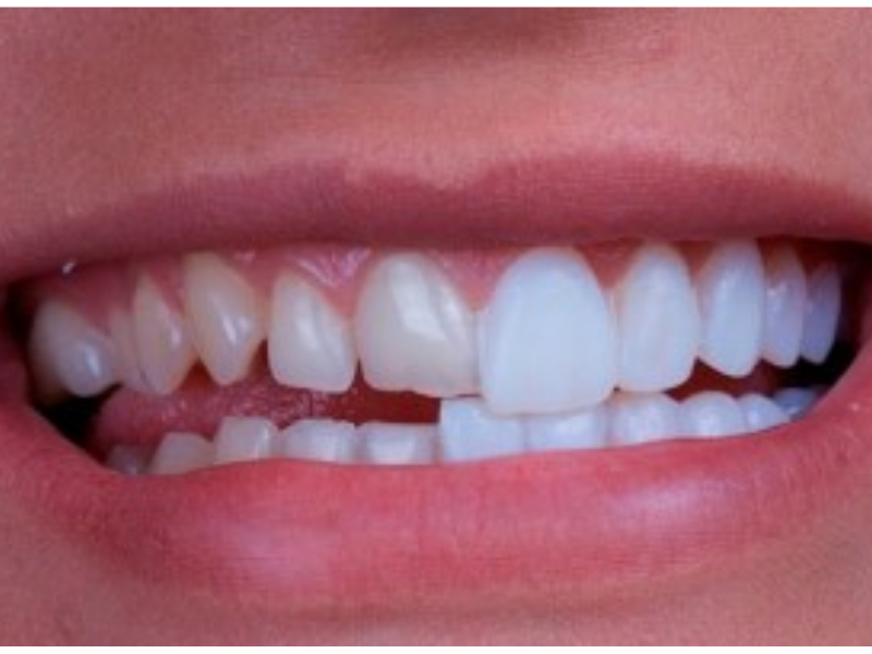 Facetas Dentárias